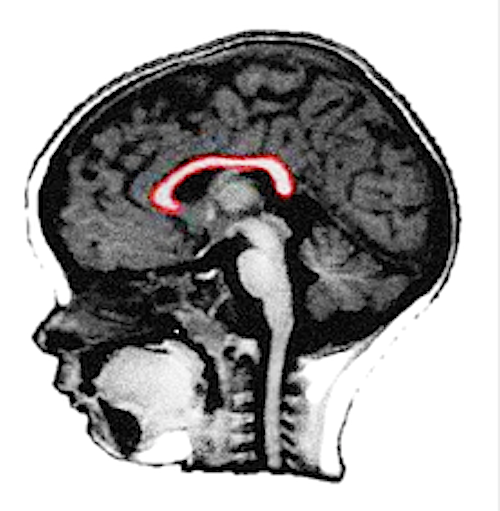 Infant  brain corpus callosum